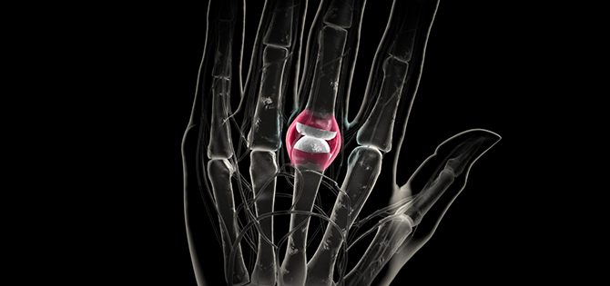 drawing of hand x ray with finger joint swelling