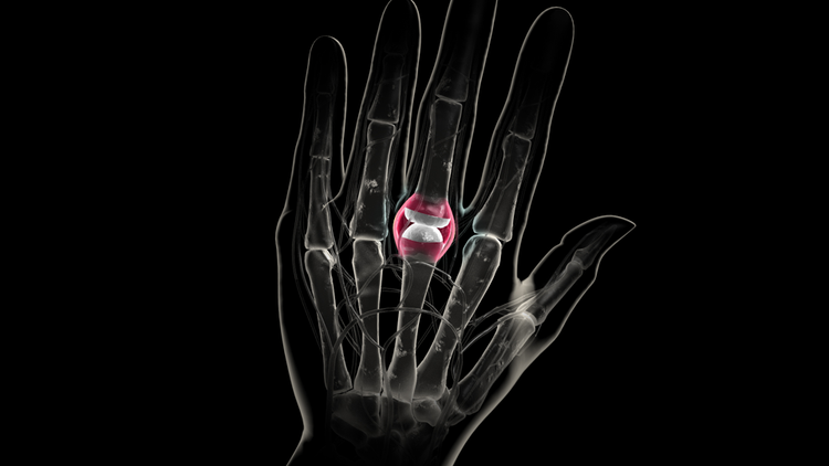 drawing of hand x ray with finger joint swelling